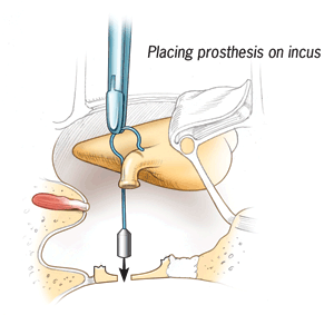 Placing prosthesis on incus