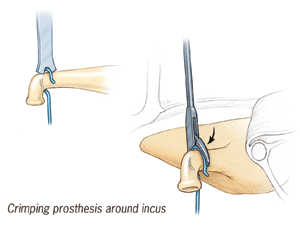 Crimping prosthesis around incus