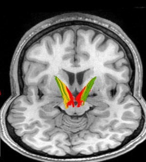 A brain, viewed from behind in two planes, showing the pathways implicated in addiction. The pathway travels from dopamine neurons (central) to areas in the striatum.