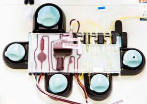 An apheresis kit separates red blood cells from platelets and plasma. The red cells are returned to the donor; the platelets and plasma are used for treatments.